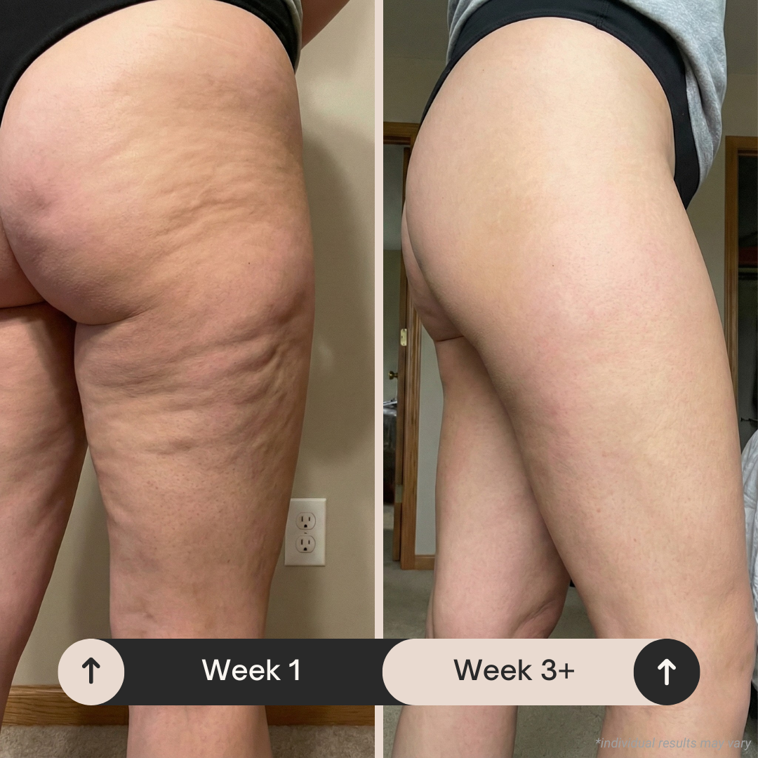 Thigh cellulite before and after